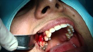 Fratura dental vertical implante imediato  VERTICAL TOOTH FRACTURE Immediate implant [upl. by Cilla]