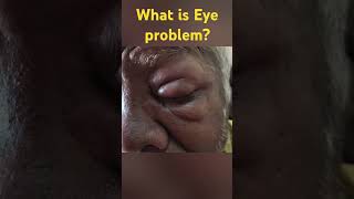 What is eye problem or diagnosis [upl. by Eerdua]