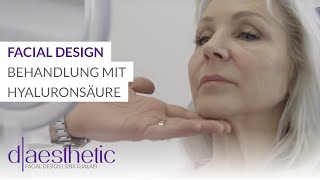 Facial Design  Behandlung mit Hyaluronsäure  daesthetic [upl. by Dur]