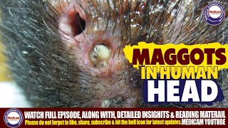 Shocking Cranial Myiasis 🧠  Maggots in Human Head🪱  Mechanical Removal [upl. by Aholla315]