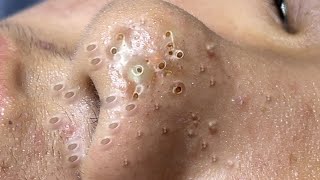 Big Cystic Acne Blackheads Extraction Blackheads amp Milia Whiteheads Removal Pimple Popping  9012 [upl. by Zetana]