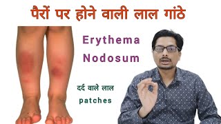 पैरों पर होने वाली लाल गांठे  दर्द वाले लाल patches  Red painful rashes amp bumps on legs erythema [upl. by Arriec]