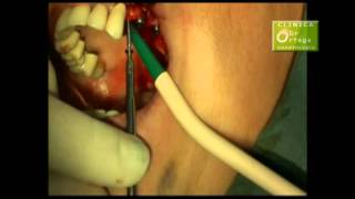 COLOCACION DE IMPLANTE CON EXPANSORES DE ROSTERDENT  WWWROSTERDENTCOM [upl. by Arlin]