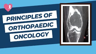 Principles of Orthopaedic Oncology and Bone Tumours for the FRCS Ortho Exam [upl. by Yffub104]