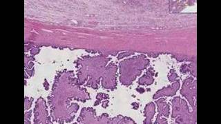 Histopathology OvaryBorderline ovarian tumor [upl. by Shawn]