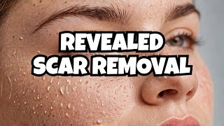 The Hidden Truth About Acne Scar Removal [upl. by Canice]