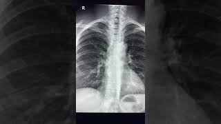 Right cardiophrenic angle opacity  Most common cause [upl. by Aneetsirhc]