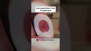 VerrucaWart Full Treatment  Wart scraping Verruca on Toe By Miss Foot FIxer [upl. by Willtrude563]