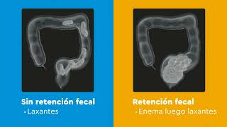 Uso de laxantes en estreñimiento Español [upl. by Arocal]