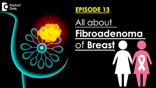 What Are Fibroadenomas Are They Precancerous Treatment OptionsDrSreekanth Reddy Doctors Circle [upl. by Desdamonna]