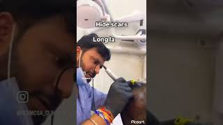 micropigmentation scalp noninvasive treatment hair hairrestoration haircaretips skincare [upl. by Jehial]