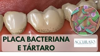 Placa Bacteriana e Tártaro [upl. by Tolley]