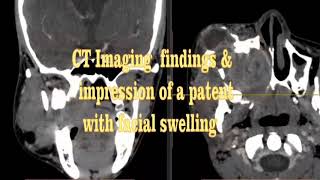 Maxillary mass [upl. by Lsil]