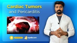 Cardiac Tumors and Pericarditis  Pathology Lectures  Medical Student  VLearning [upl. by Aicileb]