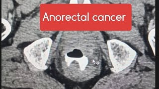 Anorectal carcinoma on CECT ctscan radiology case cancer old age doctor science facts [upl. by Avilys]