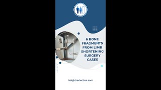 6 bone fragments from limb shortening surgery cases [upl. by Vescuso]