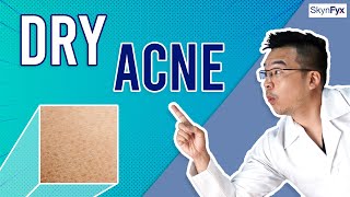 How To Treat Dry Skin  Acne Dry Acne  5 Tips To Follow [upl. by Elsy]