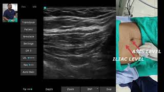 ULTRASOUND GUIDED ILIOINGUINAL amp ILIOHYPOGASTRIC NERVES SONOANATOMY [upl. by Ettevol154]