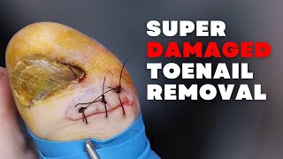 Super DAMAGED Toenail REMOVAL [upl. by Annayi]