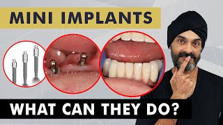 Mini Dental Implants What Can They Do [upl. by Liryc]