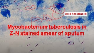 Mycobacterium tuberculosis in ZiehlNeelsen stained smear of Sputum [upl. by Wolfe]