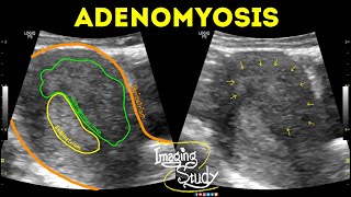 Adenomyosis  Ultrasound  Case 42 [upl. by Yornoc998]