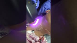 Face Laser Treatment  MR Aesthetics Lahore trending shorts youtubeshorts viralvideos explore [upl. by Tamqrah]