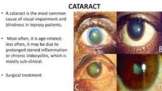 Effects of Leprosy on the Eyes [upl. by Ralston335]