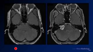 Neuroradiology board review 2 case 1 [upl. by Calista654]