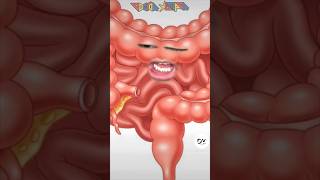 Intestino Inflamado 😨 Gases shortvideo [upl. by Mckenzie620]