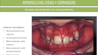 Apparecchio fisso e Espansore Prima e Dopo [upl. by Harrod664]