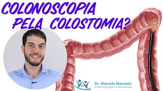 Quem tem colostomia pode fazer colonoscopia [upl. by Laris928]