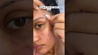 Pimple Patch Removal😱 acne pimplepatch pimplepatches acnepatch acnes acneproneskin pimplepop [upl. by Odlonyer]