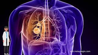 Die Rolle der Bestrahlung bei der Behandlung von Lungenkrebs [upl. by Keriann]