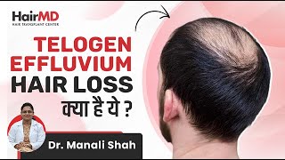 क्या है Telogen Effluvium Hair Loss  Reasons for Telogen Effluvium  HairMD Pune [upl. by Adnotal]