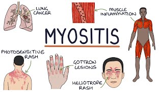 Understanding Myositis Polymyositis and Dermatomyositis [upl. by Ynatsyd]