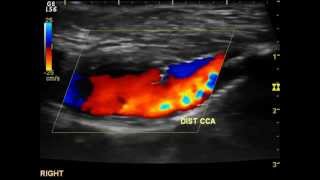 Cardio Vascular Ultrasound Carotid Doppler VNUS Closure Arterial Doppler AAA and others [upl. by Ross]