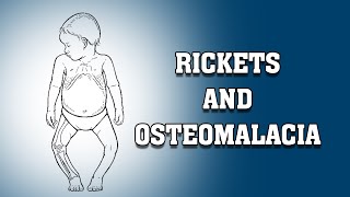 RICKETS AND OSTEOMALACIA [upl. by Aremahs]