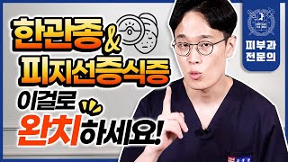 한관종 피지선증식증 재발하지 않는 가장 확실한 치료법을 알려드립니다 [upl. by Aisorbma429]