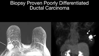 Biopsy Proven Poorly Differentiated Ductal Carcinoma [upl. by Nosnarb]