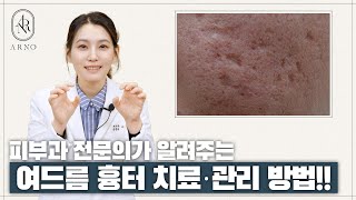 여드름 흉터가 개선이 어려운 이유 절대 이것은 하면 안 됩니다 피부과 전문의가 알려주는 여드름 흉터 관리 꿀팁아르노피부과 [upl. by Uriiah]