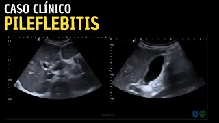 Caso clínico 109 Pileflebitis  Tromboflebitis venosa portal supurativa [upl. by Notyad]