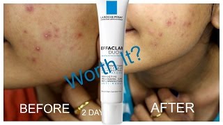 La Roche Posay Effaclar Duo Review  Worth it [upl. by Grati364]