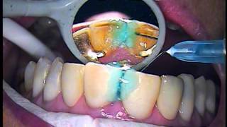 Cosmetic and functional bonding technique  Teeth numbers 8 and 9  Dr Gerard Cuomo [upl. by Fricke]