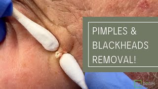 Pimples and Blackheads Removal  Dr Derm [upl. by Valenka604]