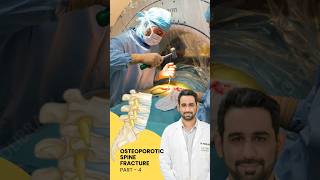 Treatment of Osteoporotic spine fracture  Dr Dheeraj Batheja  Part 2 doctor spinehealth [upl. by Stover]