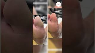 Big Toe Callus Removal [upl. by Tower]