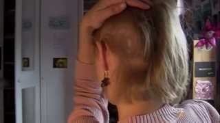 Trichotillomania Why These Women Rip Out Their Own Hair [upl. by Niveg341]