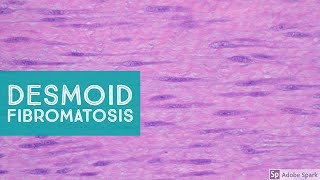 Desmoid Fibromatosis Desmoid Tumor  Explained by a Soft Tissue Pathologist [upl. by Cloe]