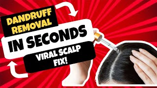 Extreme Dandruff Removal  Most Satisfying Scalp Cleanup [upl. by Cecily]